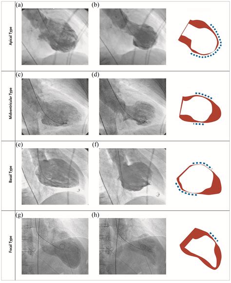 Takotsubo Syndrome: A Review of Presentation, Diagnosis 